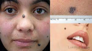 Teksturnya cukup bervariasi, ada yang kasar, halus. Tak Perlu Operasi 6 Bahan Dapur Ini Bisa Hilangkan Tahi Lalat Dalam Sekejap Tribun Pontianak