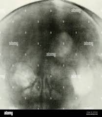 Image result for Nuclear Ventriculogram