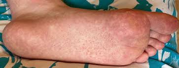 Maybe you would like to learn more about one of these? Rare Cutaneous Manifestation Of Covid 19 Bmj Case Reports