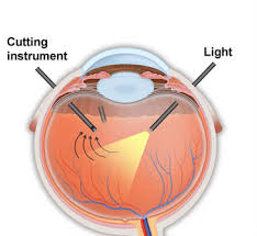 Maybe you would like to learn more about one of these? Retinal Detachment Los Angeles Pars Plana Vitrectomy Santa Monica