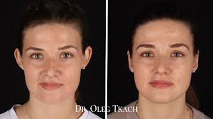 Результат пластики ушей