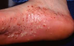 Prevalence and treatment of psoriasis in the united kingdom: Diagnosticul DiferenÈial In Psoriazisul Pustulos Health Beauty Online Journal
