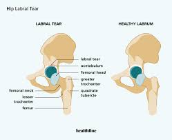 Image result for Hip Labral Tear