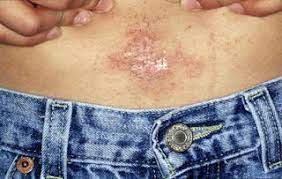 Identifying A Nickel Allergy While We Ve All Heard Of People Having Allergy Dust Mite Dog Or Cat Allergy Peanut Alle Rash On Face Nickel Allergy Skin Problems