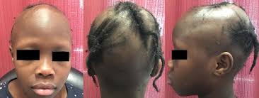 We did not find results for: 7 Year Old Female With Complete Loss Of Eyebrows With Hypopigmentation Download Scientific Diagram