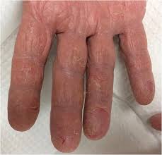 We did not find results for: Occupational And Hand Dermatitis A Practical Approach Springerlink