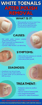 Check spelling or type a new query. White Patches On Toenails Causes Signs Best Treatment