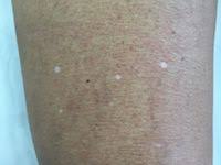 leucodermias solares dermatologia e saude dermatologia manchas brancas na pele manchas brancas