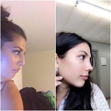 For nose jobs, chin augmentation, liposuction, breast reshaping and more. Ama I Got A Nose Job In Turkey Canadian Plasticsurgery