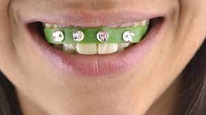 Another reason for which you may need braces is the far teeth. How To Make Fake Braces 11 Steps With Pictures Wikihow