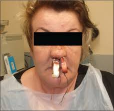 Image result for Nasal Packing