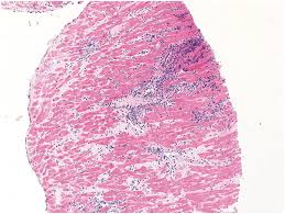 The possible pathophysiology and proposed guideline. Chapter 8 Inflammation Of The Myocardium Endocardium And Aorta Thoracic Key