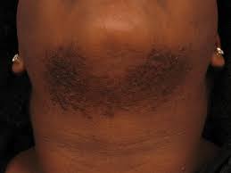 Head west which will be a right hand turn and travel one mile. Laser Hair Removal Phases Skin Care