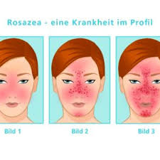 Rosazea Die Angst Vorm Rotwerden Gesundheit