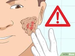 I'm assuming i have another one now. 3 Ways To Remove An Ingrown Hair Wikihow
