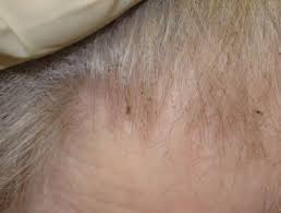 They're difficult to see, but you can feel them if you run a fingernail down they sometimes appear on eyelashes and brows, but this is rare. Head Lice Dermnet Nz