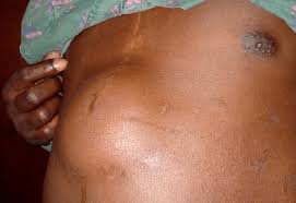 Image result for stomach hernia symptoms