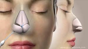 Enter virtual nose visualizers, online tools that allow you to upload a photo of your nose and manipulate its shape and size to approximate the results of surgery. Rhinoplasty Nose Job Video Animation Guncel Ozturk Md Drgo Youtube