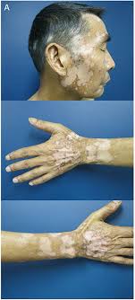 Radiotherapy may exacerbated anti‐programmed cell death 1 treatment induced  vitiligo: A case report