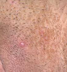 This is a distressing condition that spreads out from person to individual. Herpes Or Ingrown Hair Genital Herpes Simplex Forums Patient