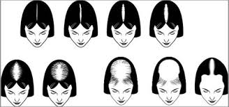Resultado de imagen para Female Pattern Baldness