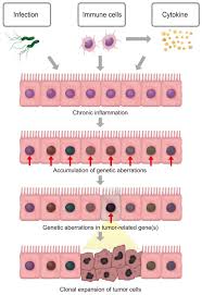 Genetic Pathogenesis of Inflammation-Associated Cancers in Digestive Organs