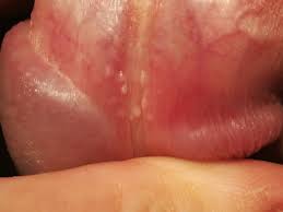 Tyson's Glands: What They Are, Why They Appear And When To Treat Them —  Your Health