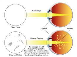 We did not find results for: Eye Floaters Flecks Spots In The Eye