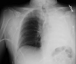 Image result for Atelectasis