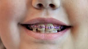 Invisible Braces - Best Orthodontist Nyc
