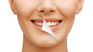 Professional Teeth Whitening vs. Over-the-Counter At-Home Teeth Whitening:  Which is Better? - Hinsdale Dental