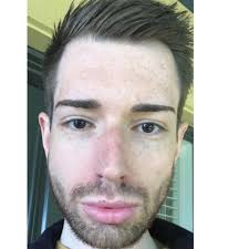 27 yo David Kosir has made the news recently, who began with  #medicalaesthetics in 2019, going for an exaggerated Ken doll look, only to  discover recently he didn't like it and dissolving