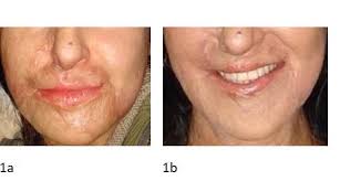 Lipofilling in Burn Sacrs: Our Experience