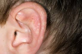 Image result for Polymorphous Light Eruption