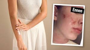 Onko sinunkin napasi alla nämä kolme kirjainta?