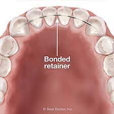 So, which retainer is best for me? Why A Bonded Retainer Might Be A Better Choice After Braces Schwenksville Dental Care