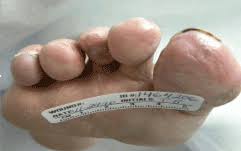 Frostbite can happen in just a few minutes or can take as long as an hour or two, depending on the frostbite is the freezing of the skin and tissue. Frostbite Pathophysiology And Treatment Options