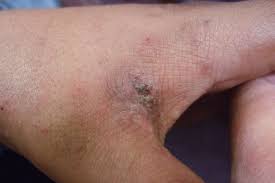 Image result for scabies human bites