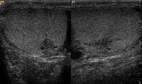 Apr 26, 2016 · tubular ectasia of the rete testis (tert) is a dilatation of the seminiferous tubules of the mediastinum testis. Tubular Ectasia Rete Testis Radiology Case Radiopaedia Org