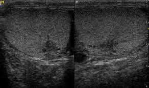 Tubular ectasia of the epididymis results in enlargement of the epididymis with multiple cystic interfaces. Tubular Ectasia Rete Testis Radiology Case Radiopaedia Org