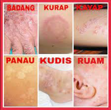Kurap disebabkan oleh jangkitan kulit oleh sejenis kulat (fungi) yang dikenali sebagai 'dermatophyte'. Petua Hilangkan Kurap Dengan Cepat Cara Semulajadi Dan Moden