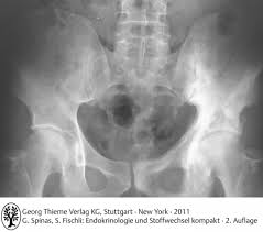 Pathophysiologie der renalen osteopathie die pathophysiologie der renalen osteopathie stellt einen komplexen zusammenhang zwischen der zugrunde liegenden. Erkrankungen Des Knochenstoffwechsels Endokrinologie Und Stoffwechsel Polybook