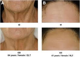 Led Light Therapy For Anti Aging Inflammatory Skin Issues