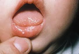 Image result for oral thrush symptoms roof of the mouth