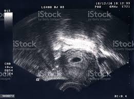 Foto De Ultrassom De Um Embriao 5 Semanas E Mais Fotos De Stock De Ultrassom Istock