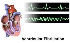 Il risultato è che la gittata cardiaca cessa completamente. Fibrillazione Ventricolare Sanita Web