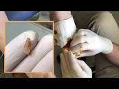 Ingrown Toenail Surgery