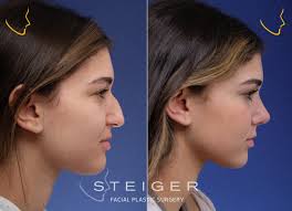 We did not find results for: Rhinoplasty Before And After Photos