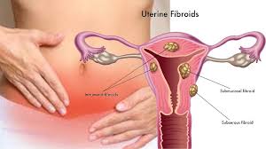 Even small fibroids can cause problems. Fibroids Causes Symptoms And Treatments Sunrise Hospitals