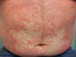 Pityriasis rubra pilaris (prp) is a rare inflammatory papulosquamous skin disease that is often refractory to conventional therapies. Pin On Health